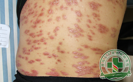 紅皮型銀屑病病因剖析