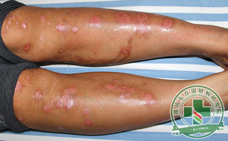 濰坊銀屑病醫院醫生詳解關節病型銀屑病病因