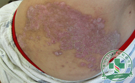 膿皰型銀屑病患者冬季如何護理