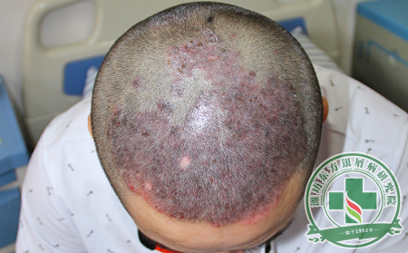 怎樣治療兒童銀屑病?