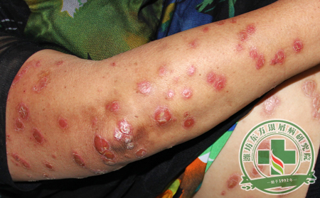 紅皮型銀屑病的治療用什么方法比較有效