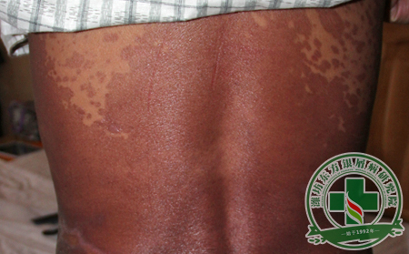 靜止期紅皮病型銀屑病如何護理