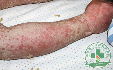 銀屑病的有效治療需要什么