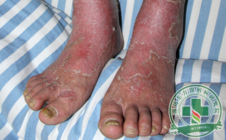 關節病型銀屑病有哪幾種類型