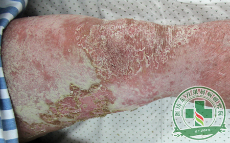 醫(yī)生淺談牛皮癬預(yù)防常識(shí)