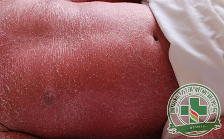 怎樣預(yù)防紅皮病型牛皮癬