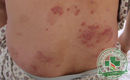 男性銀屑病患者如何降低發(fā)病率