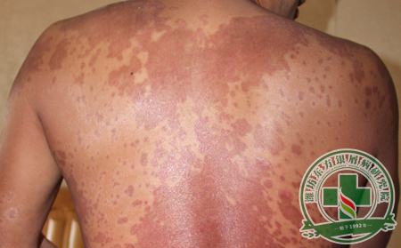 治療兒童銀屑病要注意哪些?