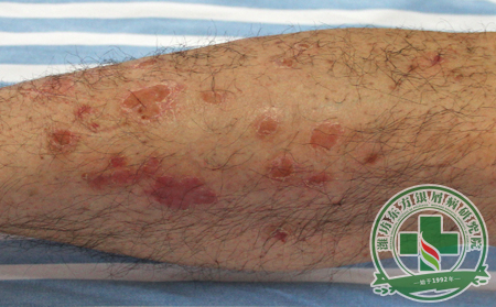 如何正確治療銀屑病?