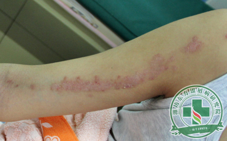 濰坊銀屑病醫(yī)院醫(yī)生淺談銀屑病治療的原則