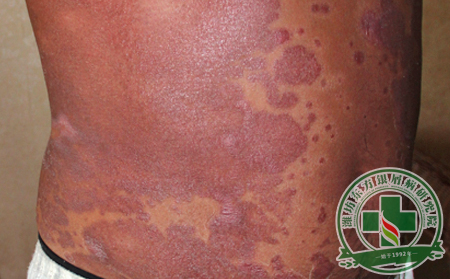 什么原因會引發銀屑病?