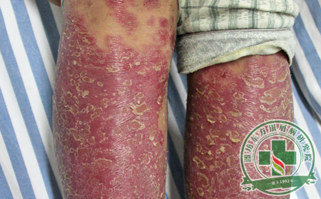 單純的感冒是否會引起銀屑病