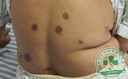 冬季銀屑病患者補(bǔ)水妙方