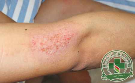 海水可以治療銀屑病嗎?