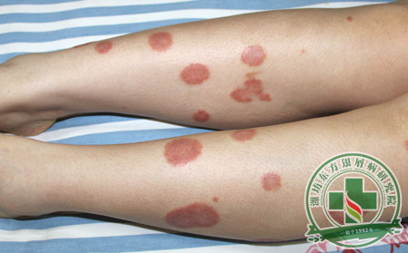 如何區分銀屑病的類型?