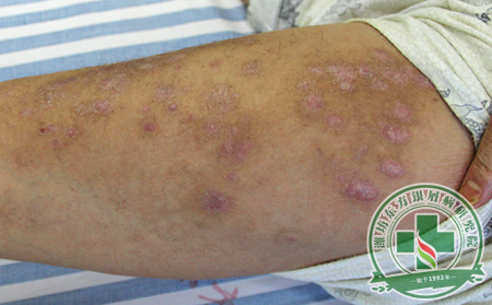 如何科學(xué)護(hù)理紅皮病型銀屑病患者