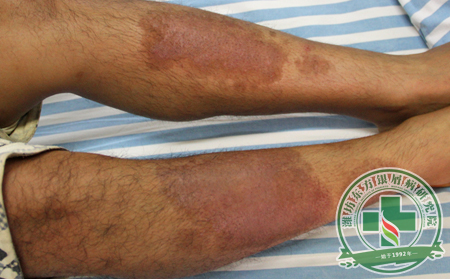 治療銀屑病需要重視起來