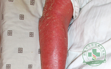 紅皮型銀屑病會導致患者內臟受損嗎