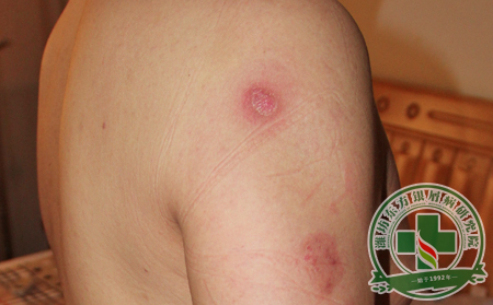 重癥銀屑病如何護理