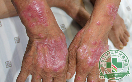 手部銀屑病癥狀及圖片
