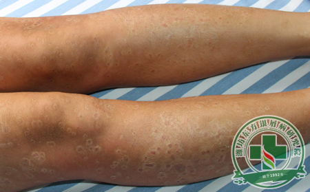 什么時候是治療銀屑病的可以時機