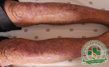 銀屑病患者要從哪些方面做好日常護理