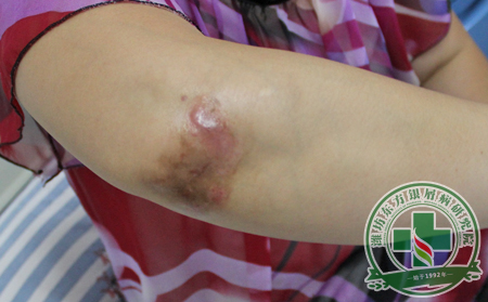 冬季銀屑病患者病情為什么會加重