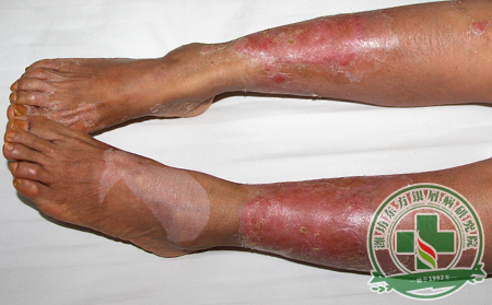 冬季銀屑病患者為什么不可以用電熱毯