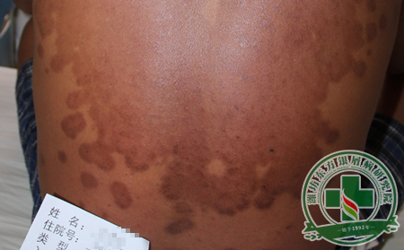 銀屑病護理之夏季飲食篇