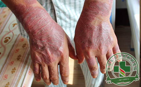 臨床治療膿皰型銀屑病要注意什么