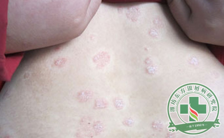 尋常型銀屑病的癥狀是如何表現的