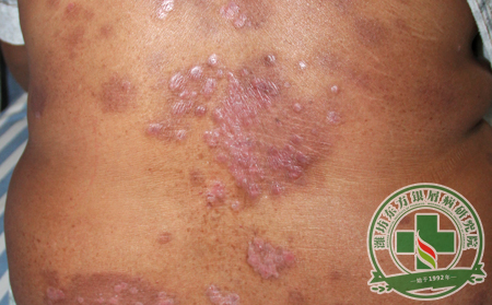 銀屑病患者夏季護(hù)理需要注意什么