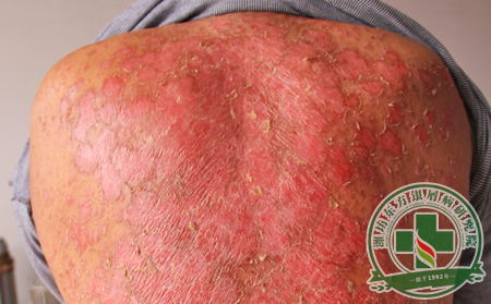 銀屑病護理之衣食住行篇