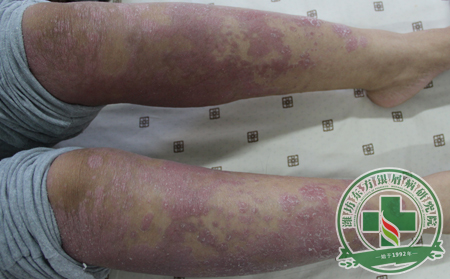 為什么城市銀屑病患者人群與時(shí)俱進(jìn)?