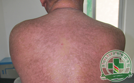 什么城市銀屑病患者人群與時俱進?