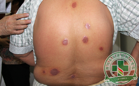 尋常型銀屑病怎么治療好