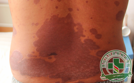 治療銀屑病需要注意的問題有哪些