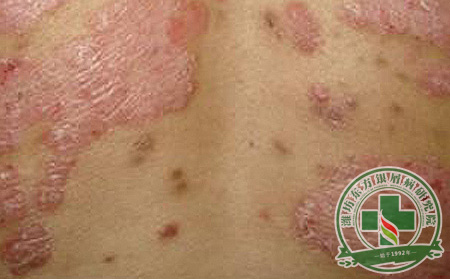 秋季銀屑病患者如何控制鱗屑脫落