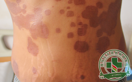 膿皰型銀屑病夏季如何進(jìn)行合理的護(hù)理