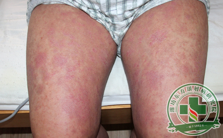 夏季銀屑病患者如何預防空調病