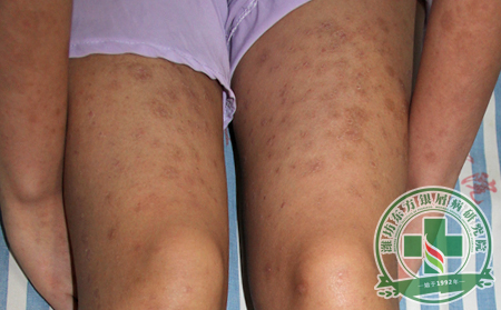 不同時期的尋常型銀屑病有什么癥狀