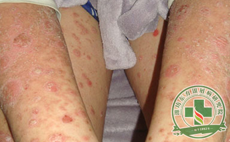 銀屑病治好后還要如何保健