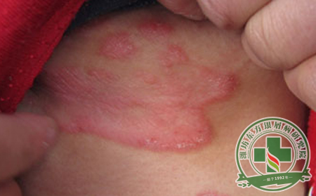 紅皮病型銀屑病的嚴重危害有哪些