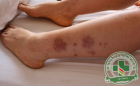 如何治療膿皰型銀屑病