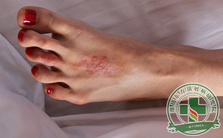 治療尋常型牛皮癬要遵循哪些原則