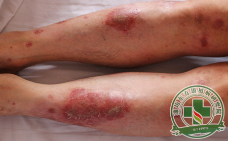 膿皰型銀屑病該如何護理飲食