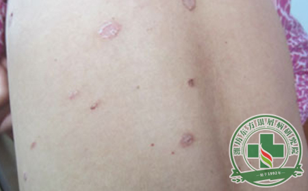 小滿節氣銀屑病患者養生原則