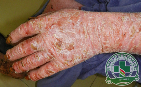 雨水節(jié)氣 牛皮癬患者要注意什么