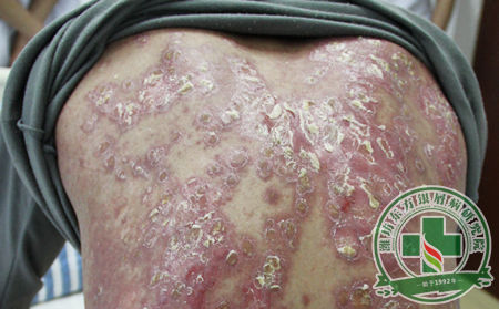 濰坊銀屑病醫(yī)院