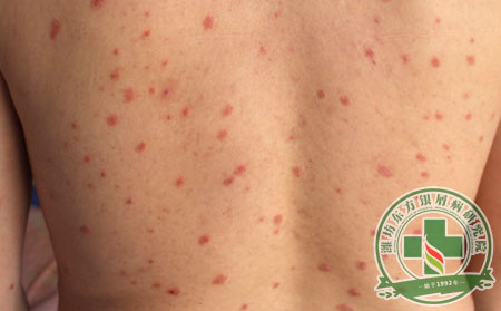 牛皮癬護(hù)理